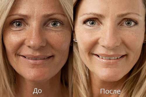 Фото до и после мезотерапии лица