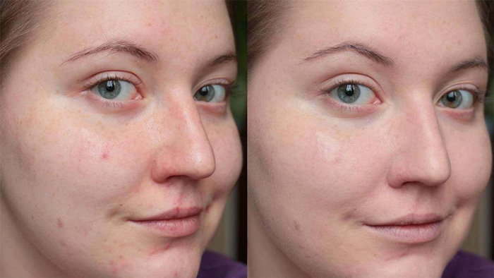 Фото до и после вакуумной чистки лица