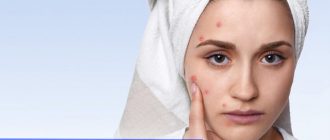 Противопоказания к применению мезотерапии от прыщей