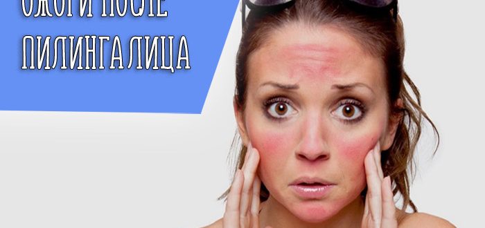 Причины появления ожога