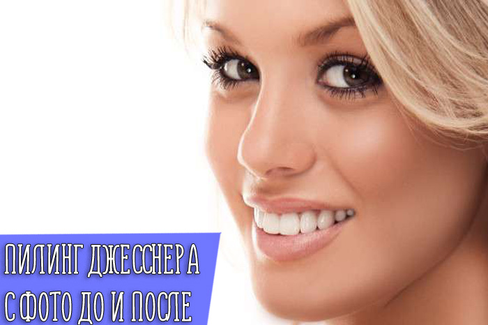 Виды пилинга Джесснера