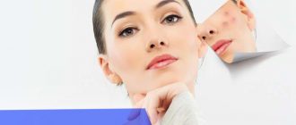 Можно ли делать пилинг при прыщах?