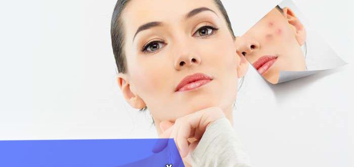 Можно ли делать пилинг при прыщах?