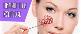 Эффективность пилинга при куперозе