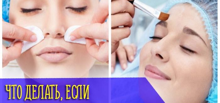 Вы выбрали щадящий пилинг