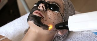 Карбоновый пилинг