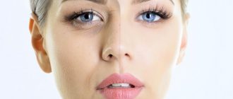 Пилинг после ботокса