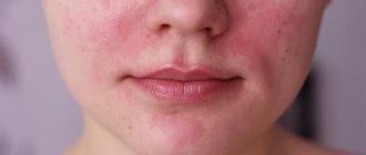 Ожог на лице после крема
