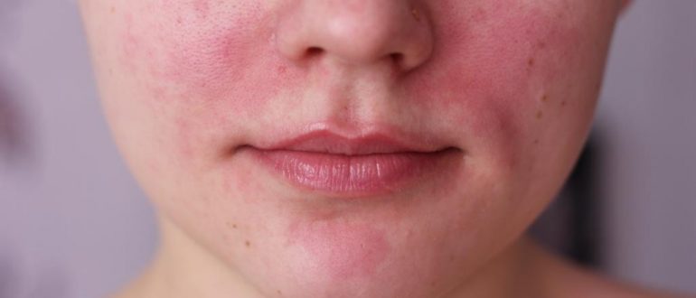 Ожог на лице после крема