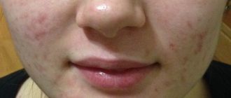 Себорейный дерматит