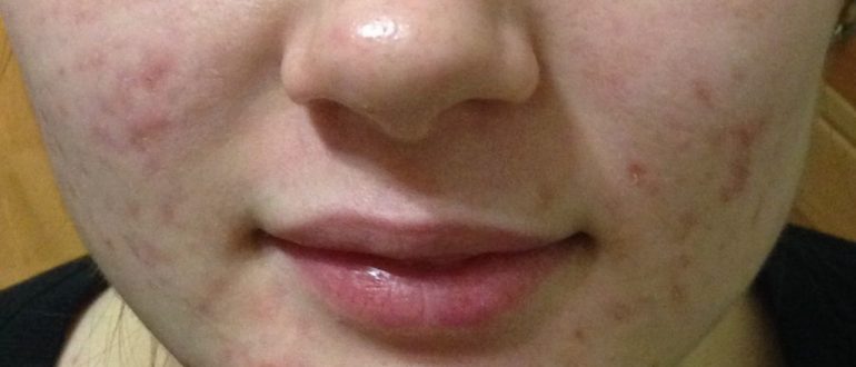 Себорейный дерматит