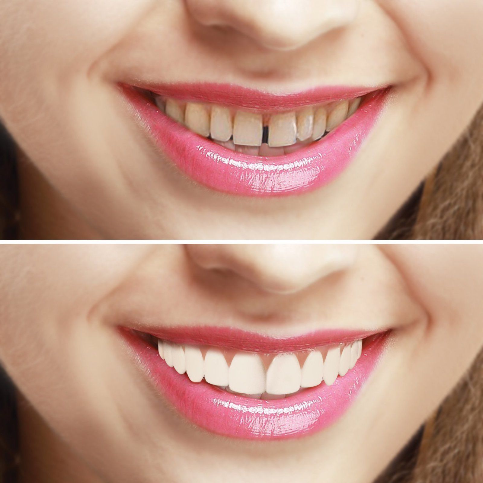 Преимущества Perfect Smile Veneers
