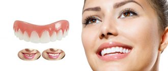 Perfect Smile Veneers