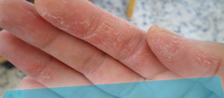 Что делать, если кожа на пальцах рук шелушится причины и лечение