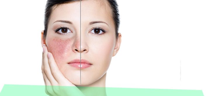 Что делать, если на лице появилась краснота, шелушение и зуд