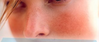 Что делать, если нос шелушится – причины и лечение