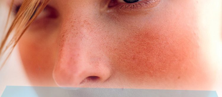 Что делать, если нос шелушится – причины и лечение