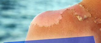 Что делать, если после загара начала шелушится кожа
