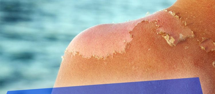 Что делать, если после загара начала шелушится кожа