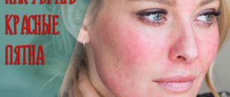 Что делать если появилось красное пятно на коже, которое чешется и шелушится