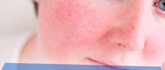 Что делать если появилось красное пятно на коже, которое не чешется и не шелушится