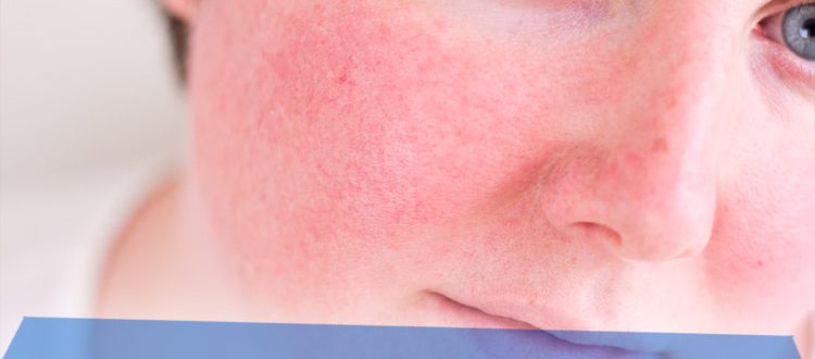 Что делать если появилось красное пятно на коже, которое не чешется и не шелушится