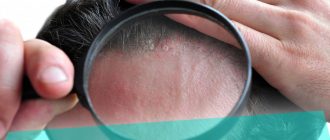 Что делать если шелушится кожа на голове – причины и лечение проблемы