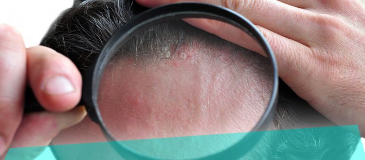 Что делать если шелушится кожа на голове – причины и лечение проблемы