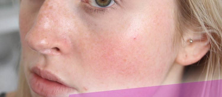 Что делать и как лечить красные шелушащиеся пятна на лице у взрослых и детей