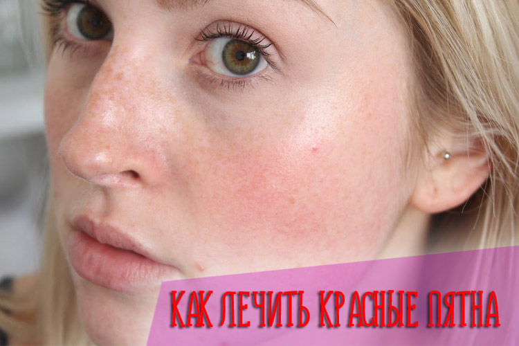 Что делать и как лечить красные шелушащиеся пятна на лице у взрослых и детей