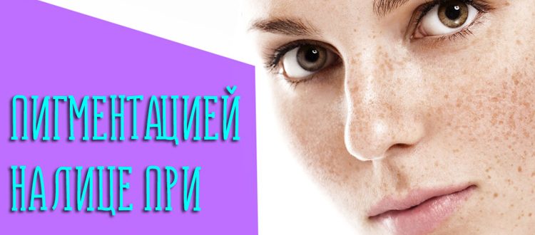 Как бороться с пигментацией на лице при беременности