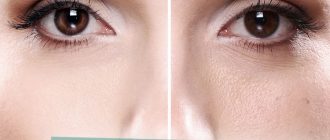 Как избавиться от расширенных пор на лице в домашних условиях – отзывы