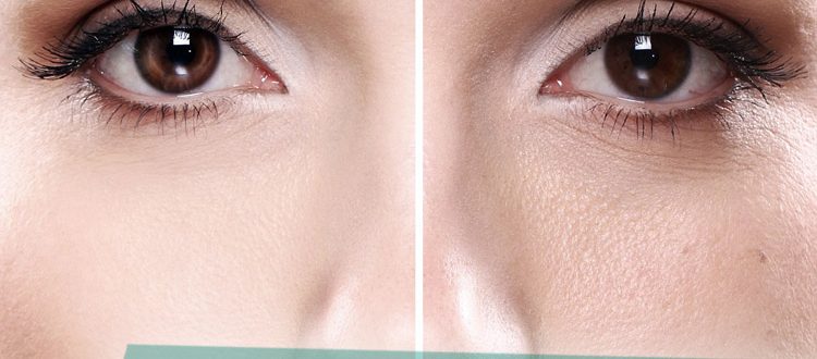 Как избавиться от расширенных пор на лице в домашних условиях – отзывы