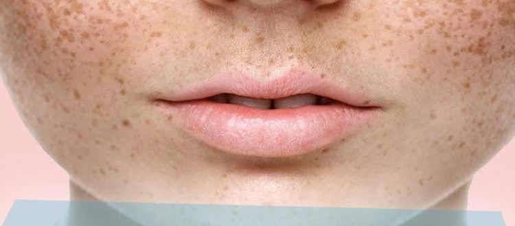 Как избавиться от возрастной пигментации на коже лица