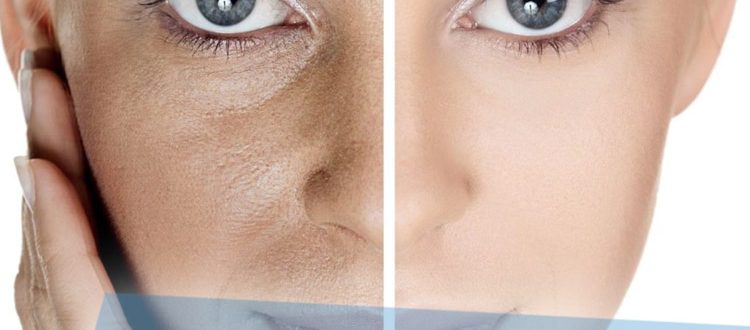 Как замаскировать поры на лице – полезные советы по уходу за проблемным лицом