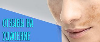 Реальные отзывы с фотографиями до и после удаления пигментации лазером