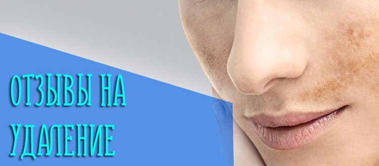 Реальные отзывы с фотографиями до и после удаления пигментации лазером