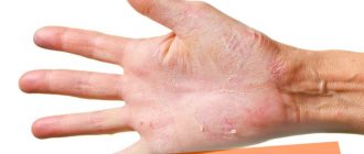 Шелушатся ладони и пальцы рук, причины и лечение кожи