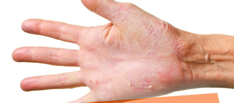 Шелушатся ладони и пальцы рук, причины и лечение кожи