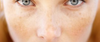 Причины пигментации на лице