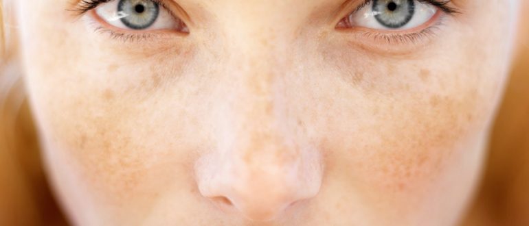 Причины пигментации на лице
