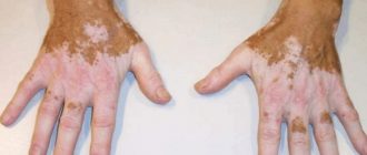Причины появления пигментации кожи на руках