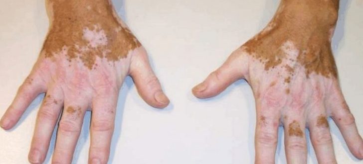 Причины появления пигментации кожи на руках