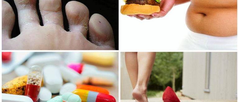 Причины шелушения кожи между пальцами ног