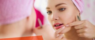 Чистка угрей на лице - советы косметологов