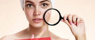 Как победить сыпь на лице – советы косметологов