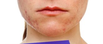 Как убрать прыщи на подбородке в домашних условиях – рекомендации косметологов