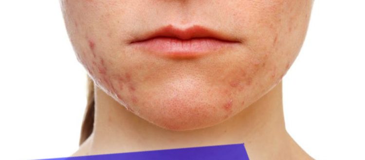 Как убрать прыщи на подбородке в домашних условиях – рекомендации косметологов