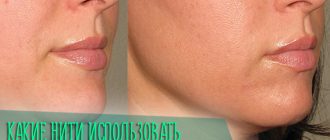 Какие нити лучше использовать для подтяжки подбородка
