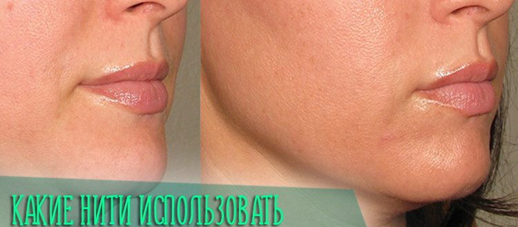 Какие нити лучше использовать для подтяжки подбородка